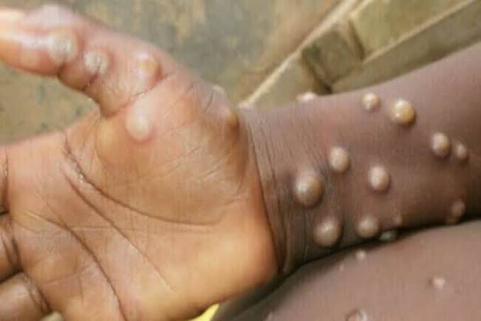  Monkeypox: Reduce sex with multiple partners, WHO warns men
