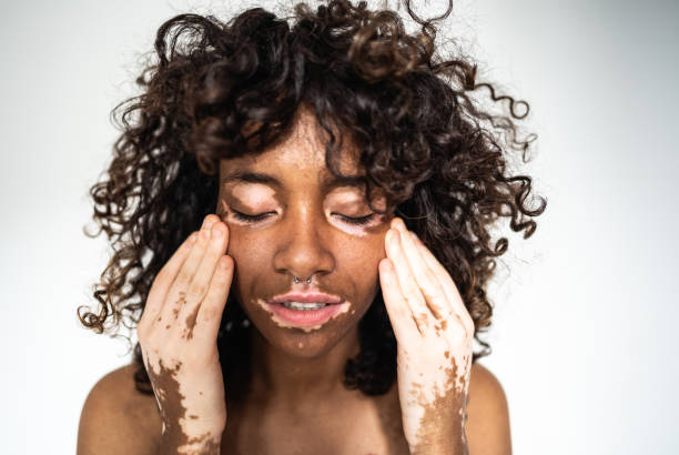  All You Need to Know About Vitiligo