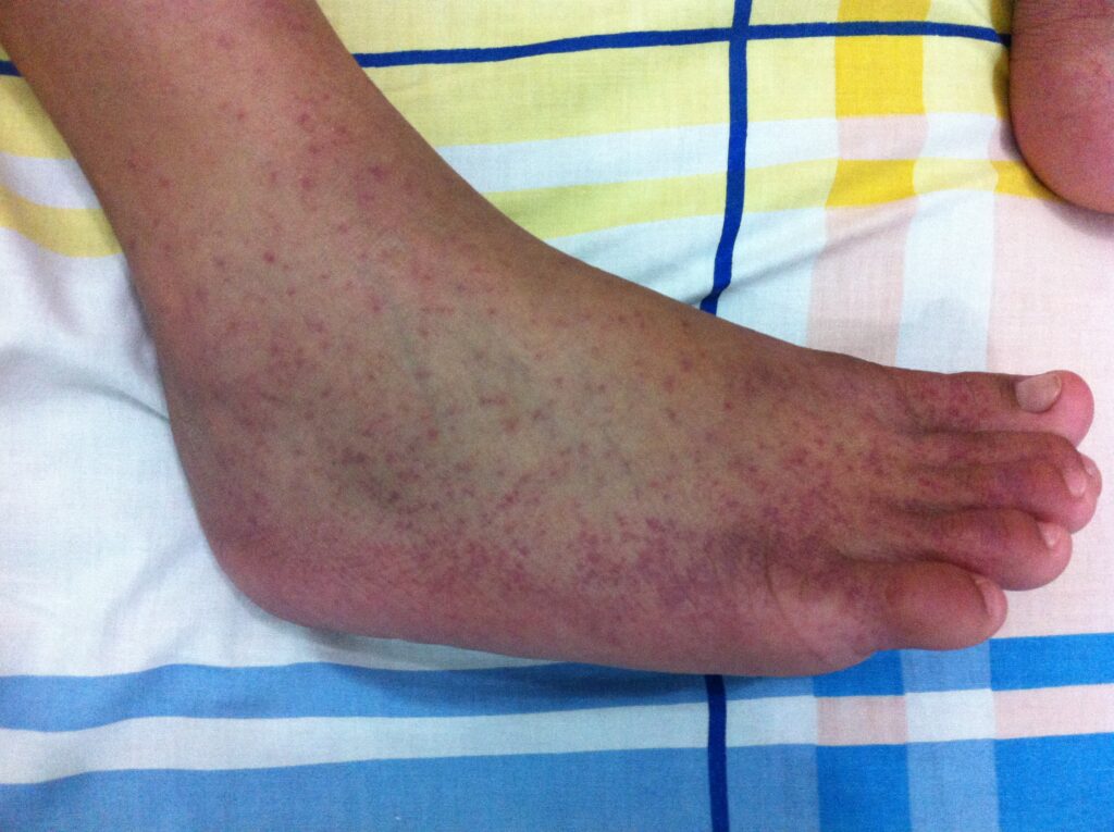 Rash from Chikungunya Virus.