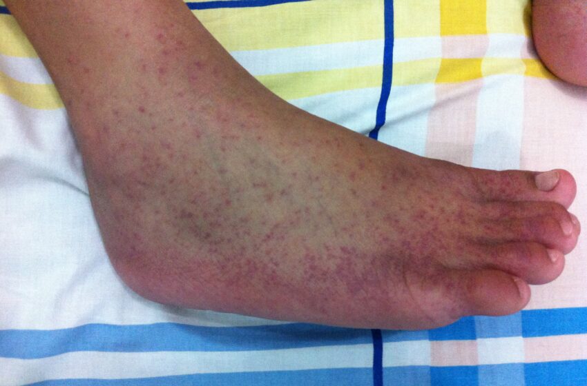 Is Chikungunya Virus the next pandemic threat after COVID-19?