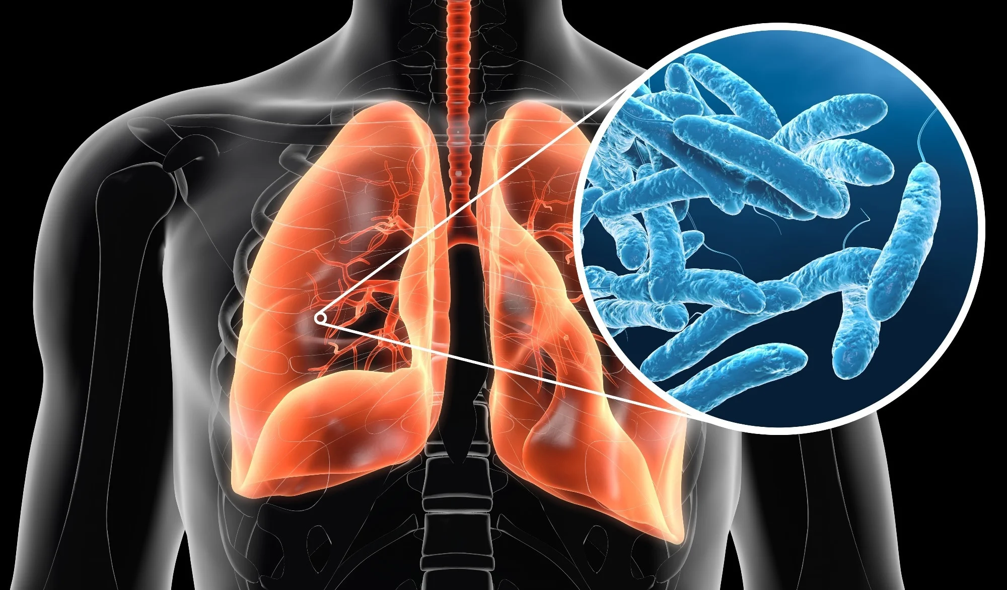 Legionnaire Disease