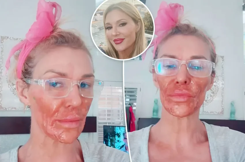 Brandi Glanville shares graphic photos after chemical burn