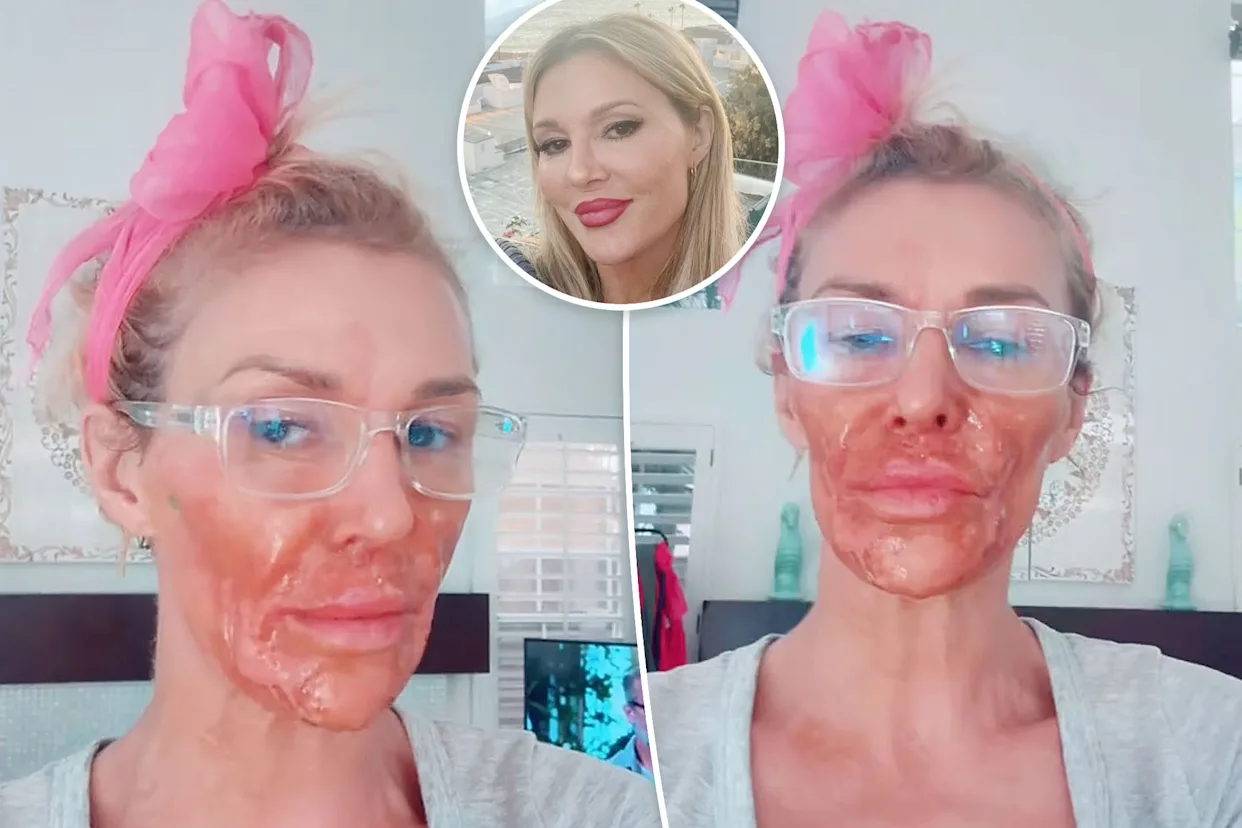 Brandi Glanville shares graphic photos after chemical burn