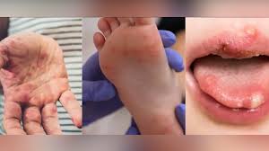 Hand, foot and mouth disease sweeps through Tennessee schools: What parents need to know about the growing outbreak