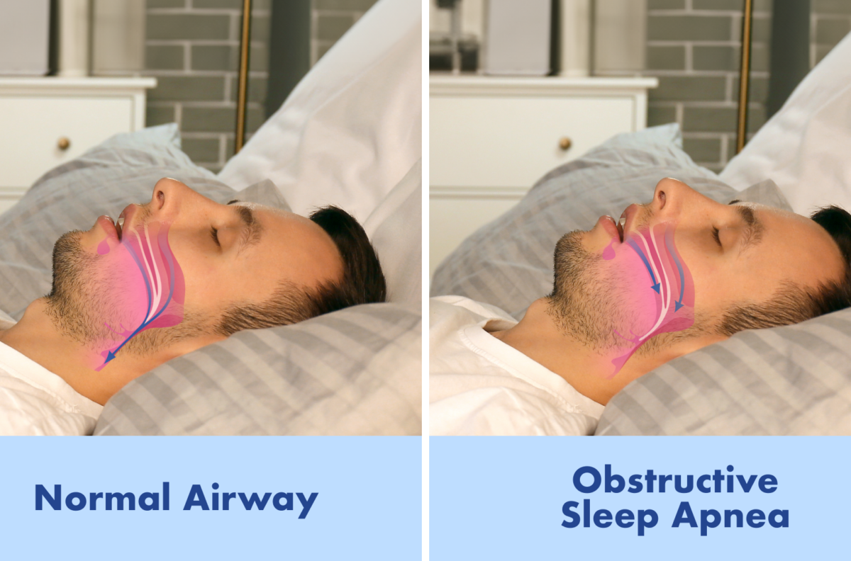  Scientists say an old Epilepsy drug could transform sleep apnea treatment with a simple nightly pill