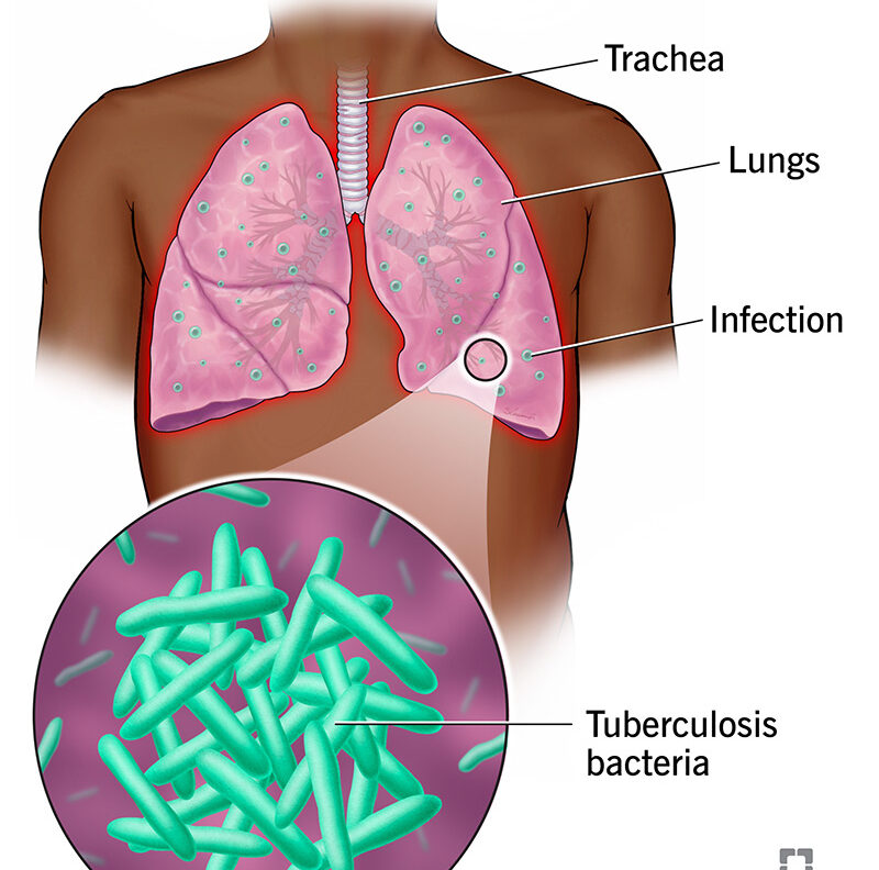  What is the TB Vaccine and why is it Important